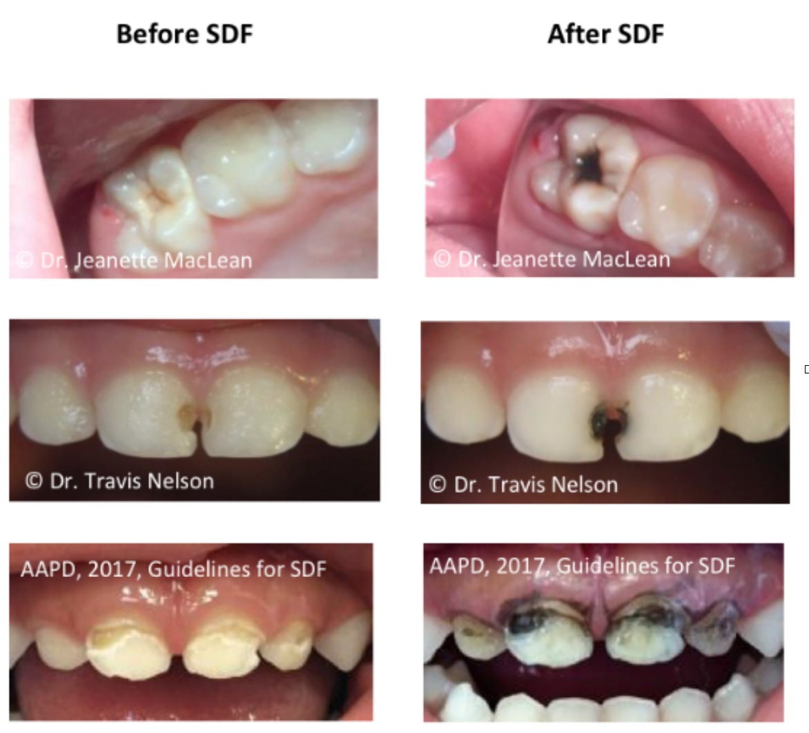 Silver diamine fluoride (sdf) - gentle dental